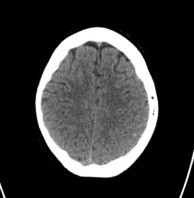 File:Cerebral arteriovenous malformation (Radiopaedia 74411-85744 Axial non-contrast 27).jpg