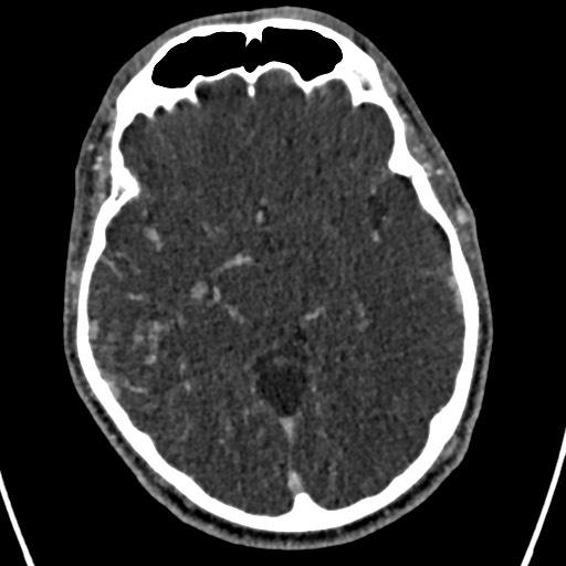 Cerebral arteriovenous malformation (Radiopaedia 78188-90746 Axial C+ delayed 76).jpg