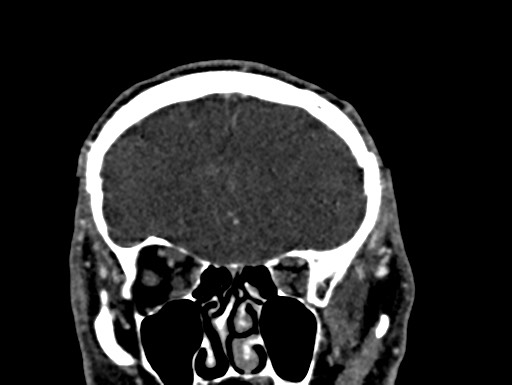 Cerebral arteriovenous malformation (Radiopaedia 78188-90746 Coronal C+ delayed 24).jpg