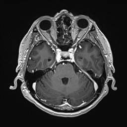 Cerebral arteriovenous malformation (Radiopaedia 84015-99245 Axial T1 C+ 54).jpg