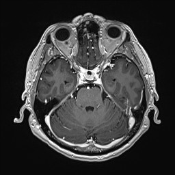 File:Cerebral arteriovenous malformation (Radiopaedia 84015-99245 Axial T1 C+ 56).jpg