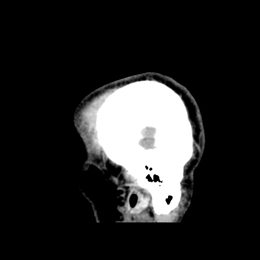 Cerebral arteriovenous malformation (Spetzler-Martin grade 2) (Radiopaedia 41262-44076 A 10).png