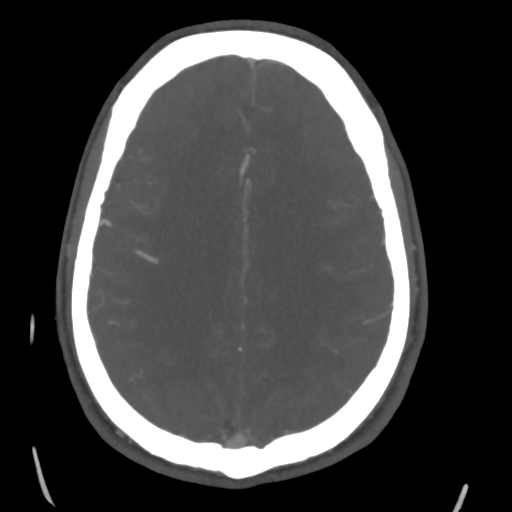 Cerebral arteriovenous malformation (Spetzler-Martin grade 2) (Radiopaedia 41262-44076 E 37).png