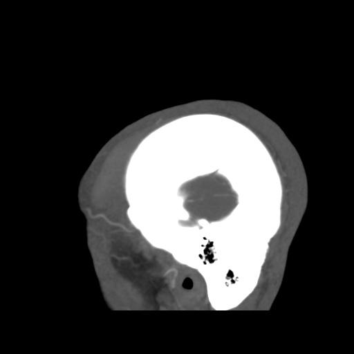 Cerebral arteriovenous malformation (Spetzler-Martin grade 2) (Radiopaedia 41262-44076 G 50).png