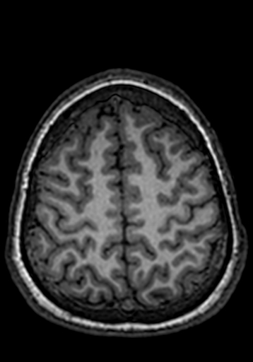 Cerebral arteriovenous malformation at posterior body of corpus callosum (Radiopaedia 74111-84925 Axial T1 49).jpg
