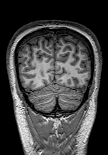File:Cerebral arteriovenous malformation at posterior body of corpus callosum (Radiopaedia 74111-84925 Coronal T1 301).jpg