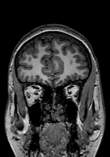 File:Cerebral arteriovenous malformation at posterior body of corpus callosum (Radiopaedia 74111-84925 Coronal T1 46).jpg