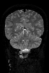 Cerebral arteriovenous malformation at posterior body of corpus callosum (Radiopaedia 74111-84925 Coronal T2 133).jpg