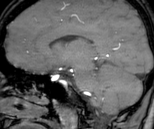 Cerebral arteriovenous malformation at posterior body of corpus callosum (Radiopaedia 74111-84925 J 221).jpg