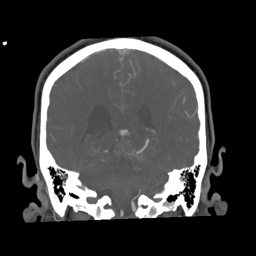 Cerebral arteriovenous malformation with lobar hemorrhage (Radiopaedia 35598-57216 C 61).jpg