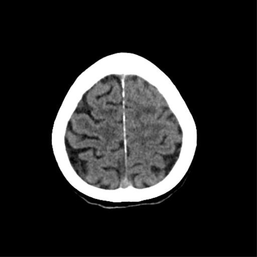 File:Cerebral arteriovenous malformation with lobar hemorrhage (Radiopaedia 44725-48510 Axial non-contrast 34).png