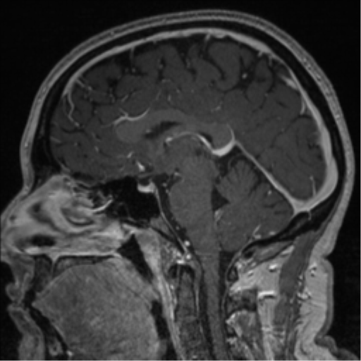 Cerebral cavernoma and development venous anomaly (Radiopaedia 37603-39482 Sagittal T1 C+ 50).png