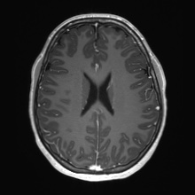 Cerebral cavernous venous malformation (Radiopaedia 70008-80021 Axial T1 C+ 52).jpg