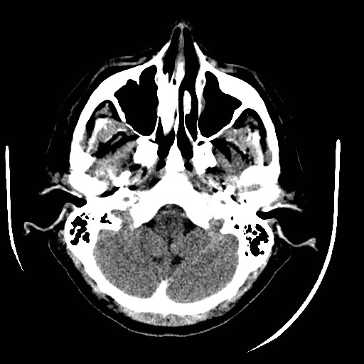 File:Cerebral edema (evolution in time) (Radiopaedia 19418-19440 non-contrast 18).jpg