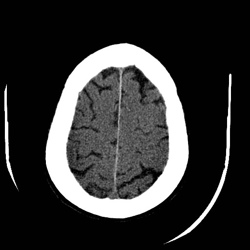 File:Cerebral edema (evolution in time) (Radiopaedia 19418-19440 non-contrast 79).jpg