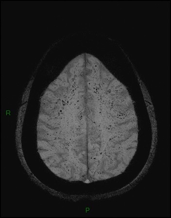 Cerebral fat embolism (Radiopaedia 35022-36525 Axial SWI 44).jpg
