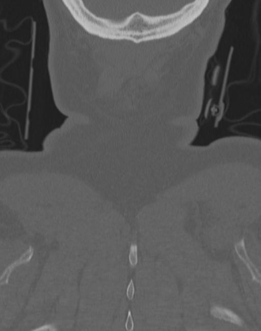 Cerebral hemorrhagic contusions and cervical spine fractures (Radiopaedia 32865-33841 Coronal bone window 78).jpg