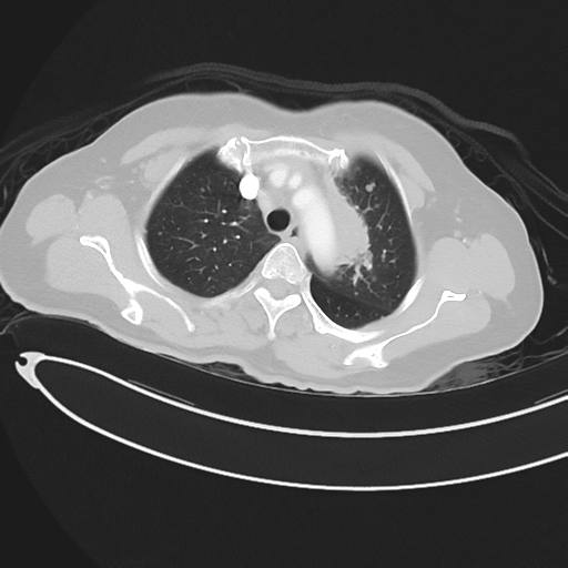 Cerebral metastases (Radiopaedia 33041-34055 Axial lung window 15).png