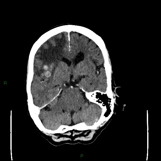 File:Cerebral metastases - breast primary (Radiopaedia 77653-89857 Axial C+ delayed 43).jpg