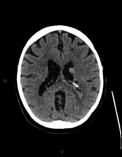 Cerebral metastases - ependymal and parenchymal (Radiopaedia 79877-93131 Axial non-contrast 44).jpg
