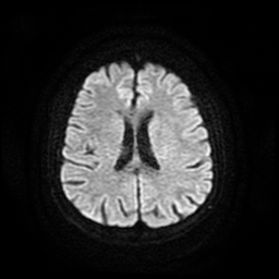 Cerebral metastases - melanoma (Radiopaedia 80972-94522 Axial DWI 51).jpg