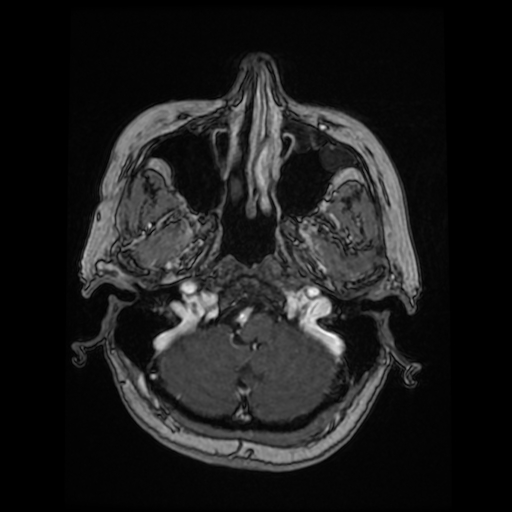 Cerebral metastases - melanoma (Radiopaedia 80972-94522 Axial T1 C+ 29).jpg