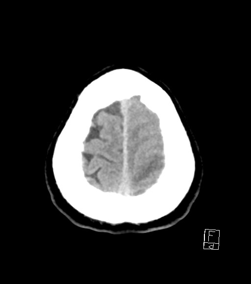 Cerebral metastases - testicular choriocarcinoma (Radiopaedia 84486-99855 Axial non-contrast 9).jpg