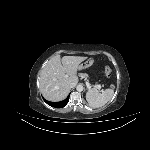 File:Cerebral metastases from lung cancer with amyloid angiopathy and cerebellopontine angle meningioma (Radiopaedia 74306-85223 A 37).jpg