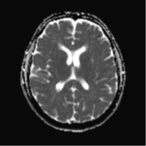 File:Cerebral metastases mimicking abscesses (Radiopaedia 45841-50131 Axial ADC 17).png