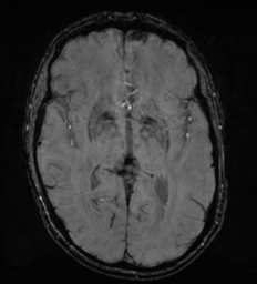 Cerebral metastasis - melanoma (Radiopaedia 54718-60954 Axial SWI 27).png