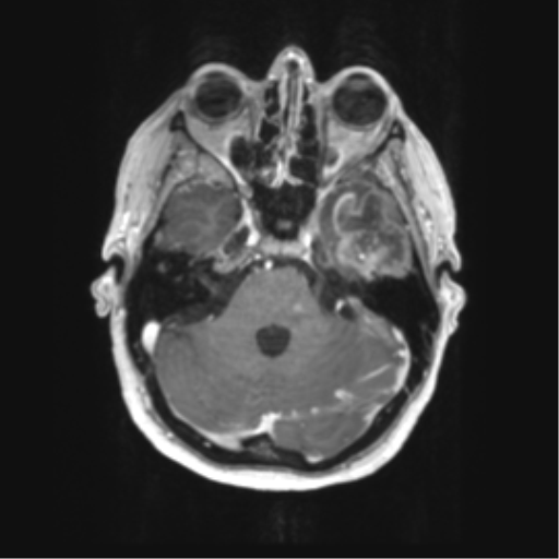 File:Cerebral metastasis mimicking glioblastoma (Radiopaedia 69155-78937 Axial T1 C+ 15).png