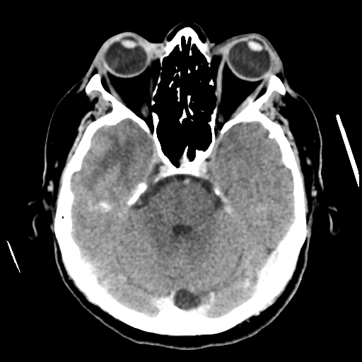 File:Cerebral metastasis to basal ganglia (Radiopaedia 81568-95412 Axial C+ delayed 20).png