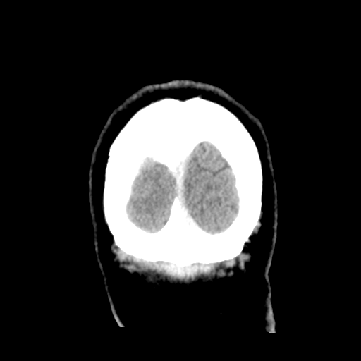 Cerebral metastasis to basal ganglia (Radiopaedia 81568-95412 Coronal C+ delayed 57).png