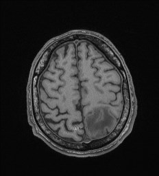 File:Cerebral toxoplasmosis (Radiopaedia 43956-47461 Axial T1 64).jpg