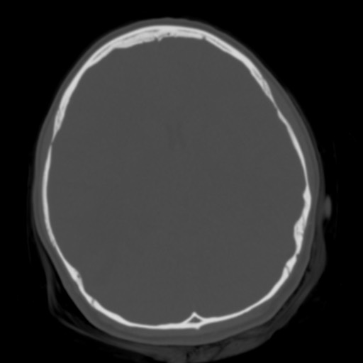 Cerebral tuberculosis with dural sinus invasion (Radiopaedia 60353-68018 Axial bone window 25).jpg