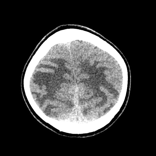 File:Cerebral tuberculosis with dural sinus invasion (Radiopaedia 60353-68018 Axial non-contrast 51).jpg