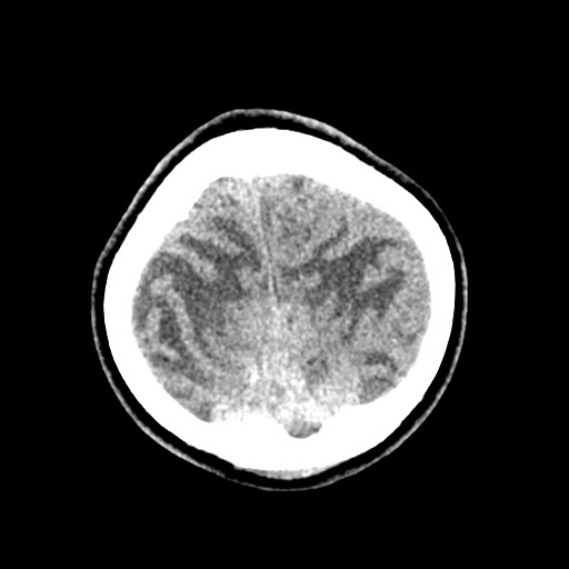 Cerebral tuberculosis with dural sinus invasion (Radiopaedia 60353-68018 Axial non-contrast 55).jpg