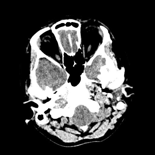 Cerebral tuberculosis with dural sinus invasion (Radiopaedia 60353-68018 Axial non-contrast 6).jpg