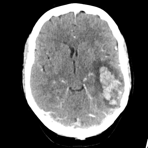 Cerebral venous hemorrhagic infarction (Radiopaedia 57576-64538 Axial C+ 20).png