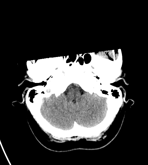 File:Cerebral venous infarct related to dural venous sinus thromboses (Radiopaedia 35292-36804 Axial non-contrast 6).png