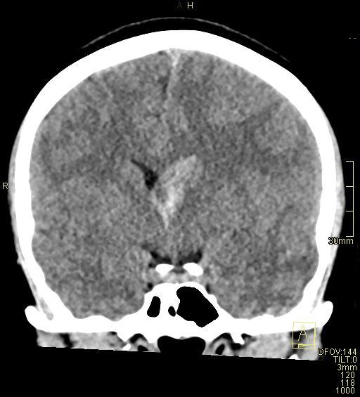Cerebral venous sinus thrombosis (Radiopaedia 91329-108965 Coronal non-contrast 25).jpg