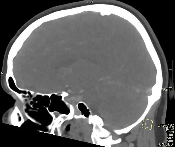 Cerebral venous sinus thrombosis (Radiopaedia 91329-108965 Sagittal venogram 33).jpg