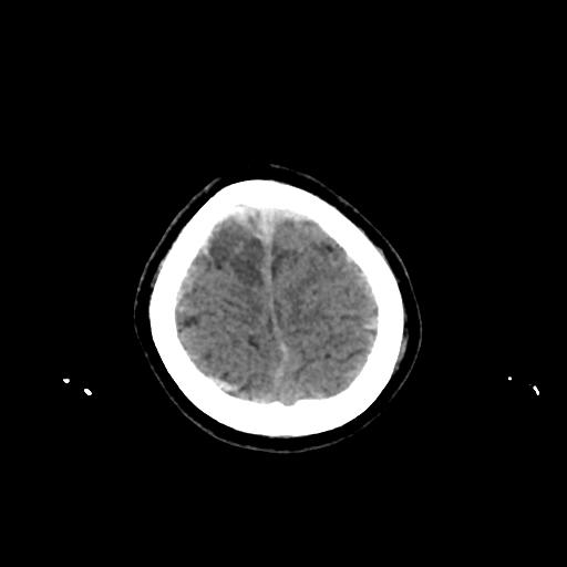 Cerebral venous throbmosis - hemorrhagic venous infarction (Radiopaedia 87318-103613 Axial non-contrast 157).jpg
