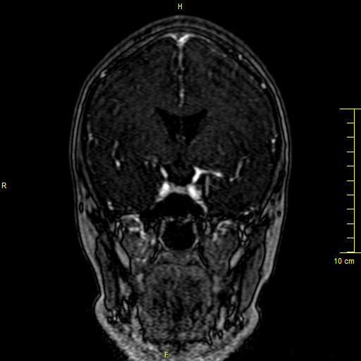 File:Cerebral venous thrombosis (Radiopaedia 23288-23351 MRV 53).JPG
