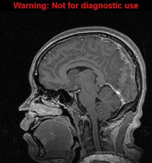 Cerebral venous thrombosis (Radiopaedia 37224-39208 Sagittal T1 C+ 82).jpg