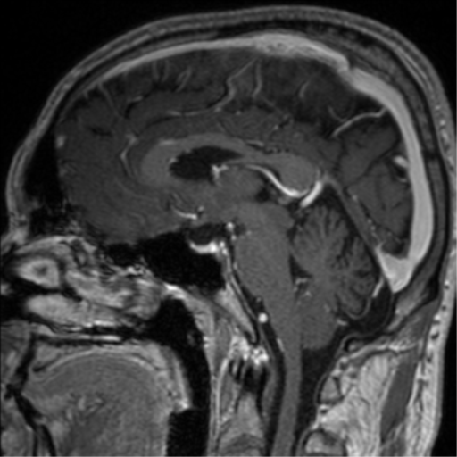 Cerebral venous thrombosis (Radiopaedia 38392-40469 Sagittal T1 C+ 47).png