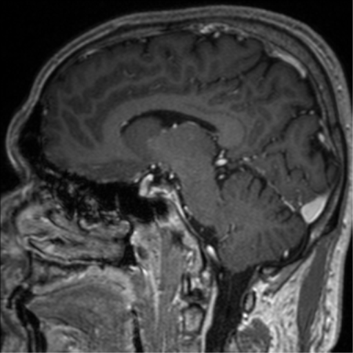 Cerebral venous thrombosis (Radiopaedia 38392-40469 Sagittal T1 C+ 50).png
