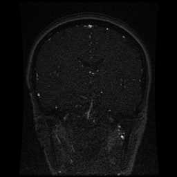 Cerebral venous thrombosis - ulcerative colitis (Radiopaedia 66049-75219 Coronal MRV 62).jpg