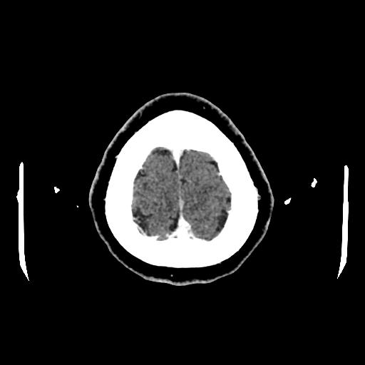 Cerebral venous thrombosis with venous hemorrhagic infarct (Radiopaedia 90354-107660 Axial with contrast 155).jpg