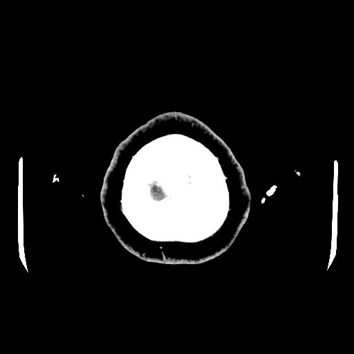 Cerebral venous thrombosis with venous hemorrhagic infarct (Radiopaedia 90354-107660 Axial with contrast 165).jpg